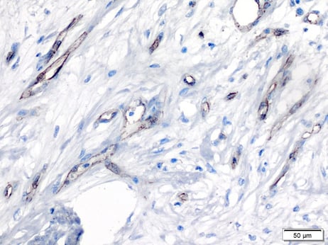 CD31 in human breast carcinoma