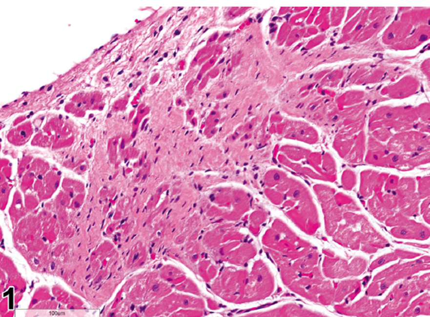 Heart, fibrosis myocardium, H&E