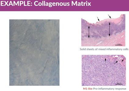 A collagenous matrix provokes an inflammatory response]